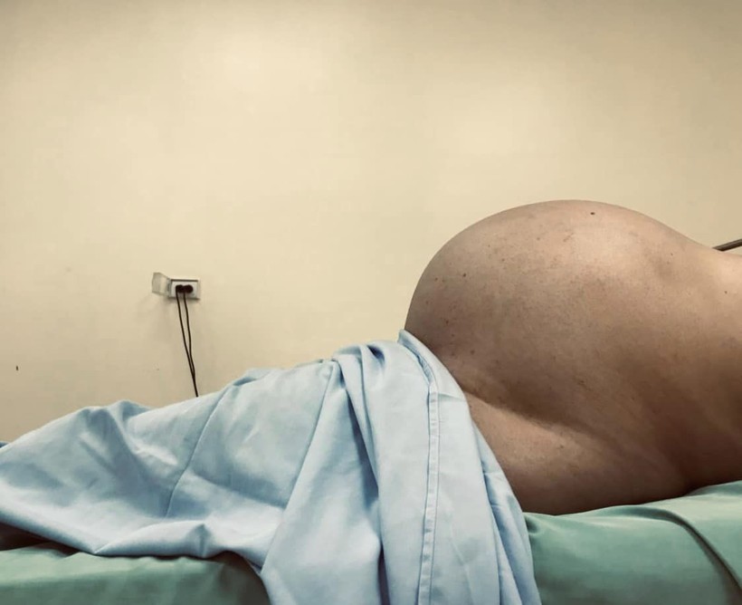 Bác sỹ ngỡ ngàng với khối u tử cung 'khủng' của bệnh nhân