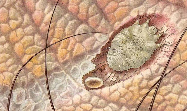 Bọ ve Sarcoptei scabieis gây bệnh ghẻ ở cơ quan sinh dục nam.