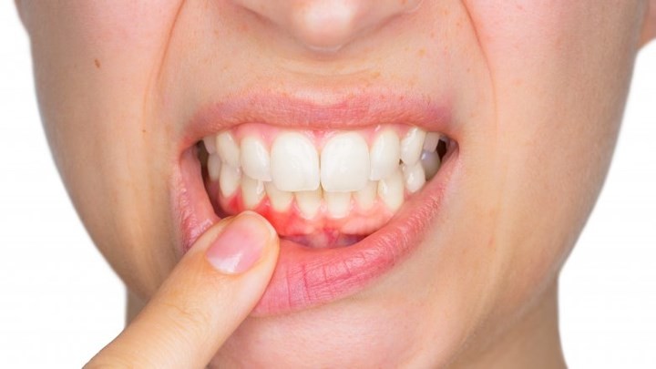 Biết những tác hại kinh hoàng này, liệu bạn còn lười đánh răng buổi sáng?