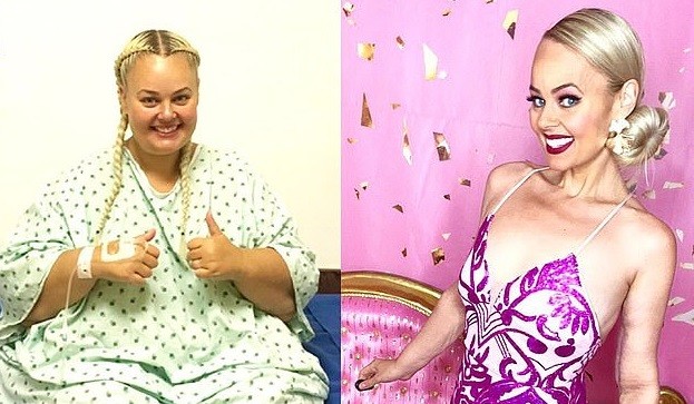 Người phụ nữ quyết cắt bỏ 80% dạ dày, giảm 90 kg để giống búp bê Barbie