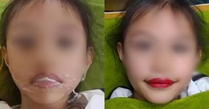 Biến chứng kinh hoàng có thể xảy ra khi xăm môi cho trẻ 5 tuổi