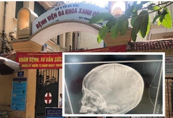 Cháu bé đang cấp cứu tại bệnh viện Xanh Pôn và hình ảnh chụp phát hiện dị vật trong hộp sọ cháu bé. Ảnh: Internet.