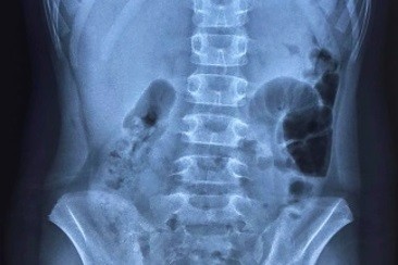 Hình ảnh chụp X-Quang bệnh nhi thể hiện liềm hơi dưới vòm hoành 2 bên, dấu hiệu chẩn đoán thủng tạng rỗng. Ảnh: Bệnh viện Trẻ em Hải Phòng.