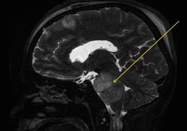 Bác sĩ xác định khối u nằm ngay phần cuống não chịu trách nhiệm kiểm soát các dây thần kinh và nhóm cơ thường gây ra phản ứng nấc cụt. Ảnh: Daily Mail.