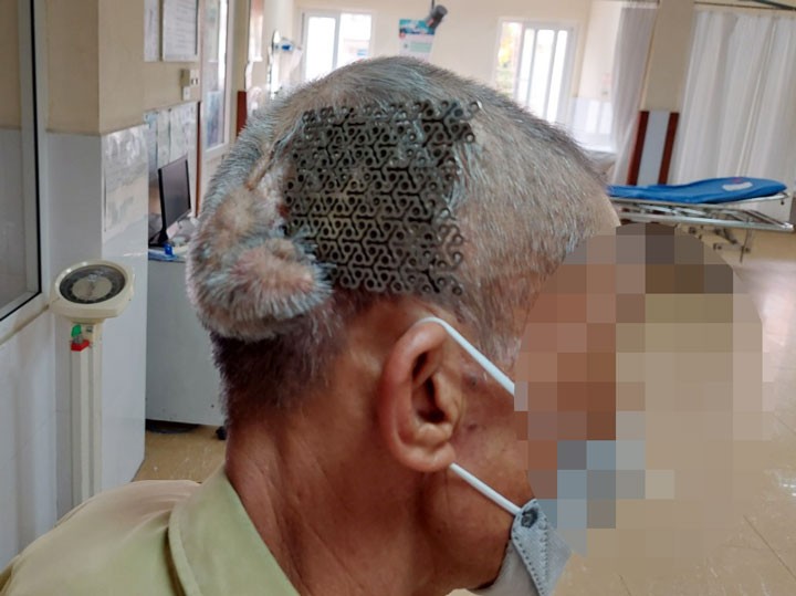 Hình ảnh lúc người bệnh nhập viện với tấm titatium hở trên sọ não.