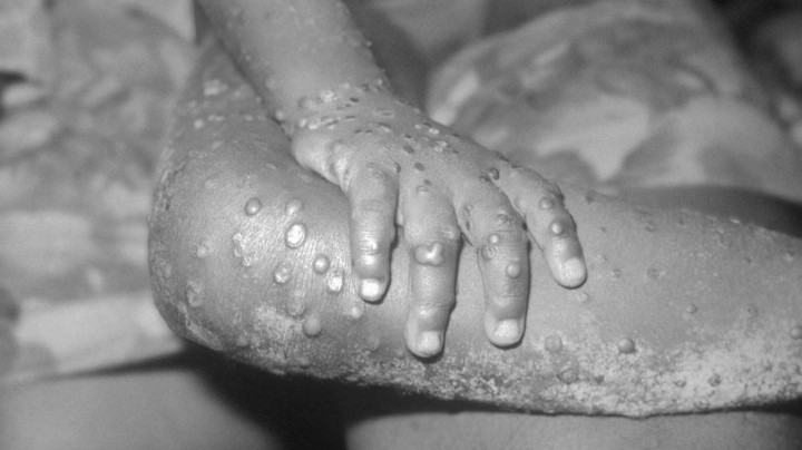 Hình ảnh tổn thương tay và chân của một bệnh nhi bị đậu mùa khỉ. Ảnh: CDC Mỹ.