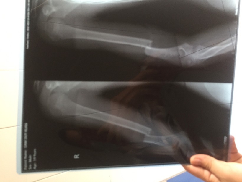 Cháu bé bị ngã xương cánh tay phải. Nguồn: Bệnh viện Đa khoa tỉnh Cao Bằng.