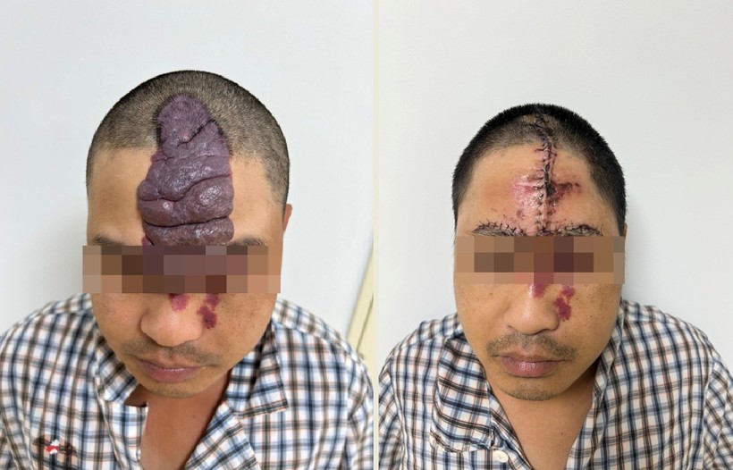 Hình ảnh của bệnh nhân trước và sau ca cắt khối dị dạng. Nguồn: BV.