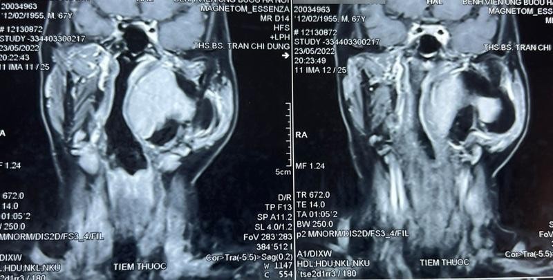 Hình ảnh chụp cộng hưởng từ khối u khoảng bên họng của bệnh nhân. Nguồn: BV.