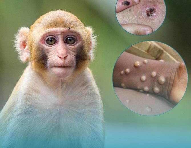Bệnh đậu mùa khỉ có các triệu chứng chính là sốt, phát ban dạng phỏng nước và sưng hạch ngoại vi, có thể gây biến chứng nặng dẫn tới tử vong. Ảnh minh họa: SYT Hà Nội.