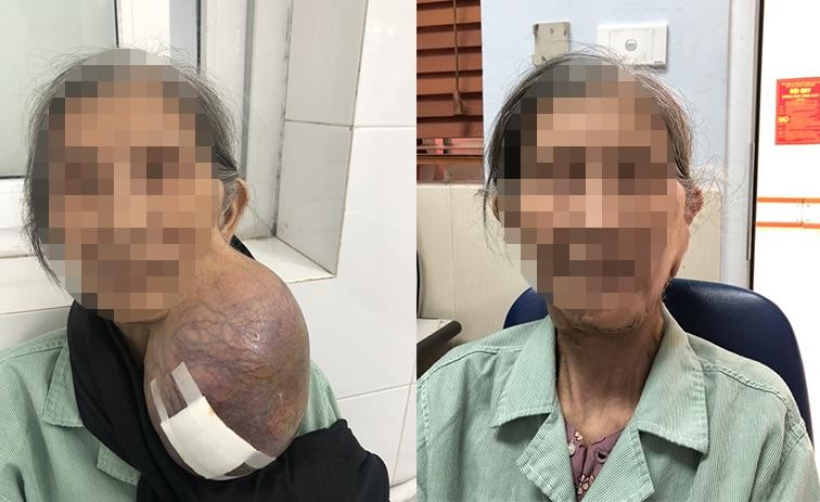 Hình ảnh bệnh nhân trước và sau khi được cắt bỏ khối u 'khủng' 'dính' trên cổ hơn 40 năm. Ảnh: BV.