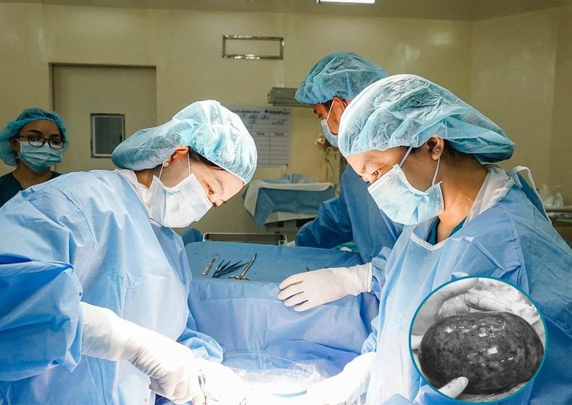 Các bác sĩ phẫu thuật cắt bỏ khối u buồng trứng bị hoại tử cho bệnh nhân. Ảnh: BV.