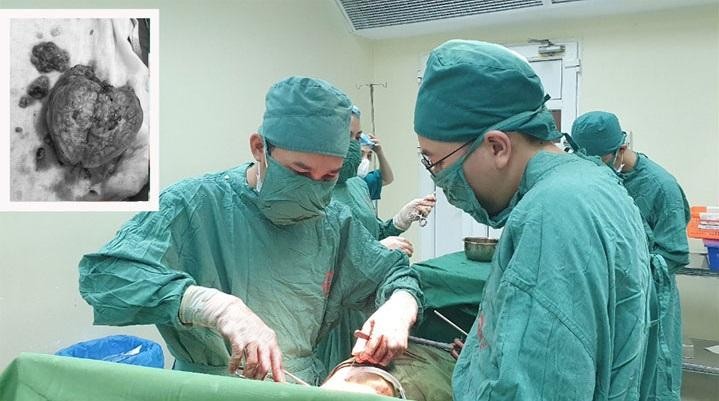 Các bác sĩ tiến hành phẫu thuật cắt bỏ khối u cho bệnh nhân. Ảnh: BV