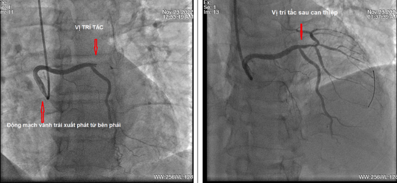 Hình ảnh chụp động mạch vành trước và sau khi can thiệp. Ảnh: BV.
