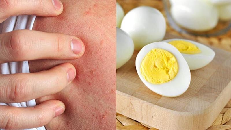 Vì sao bị dị ứng khi ăn trứng?