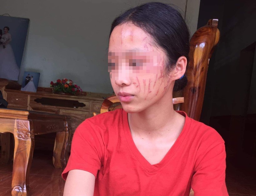 Em Lưu Thị H. (Trường PT DTBT THCS Thạch Ngàn, huyện Con Cuông, Nghệ An) bị nhiều vết thương trên mặt.