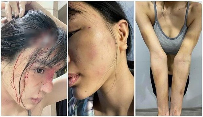 Hình ảnh trên mạng xã hội cho rằng người mẫu Khả Trang bị bạo hành.