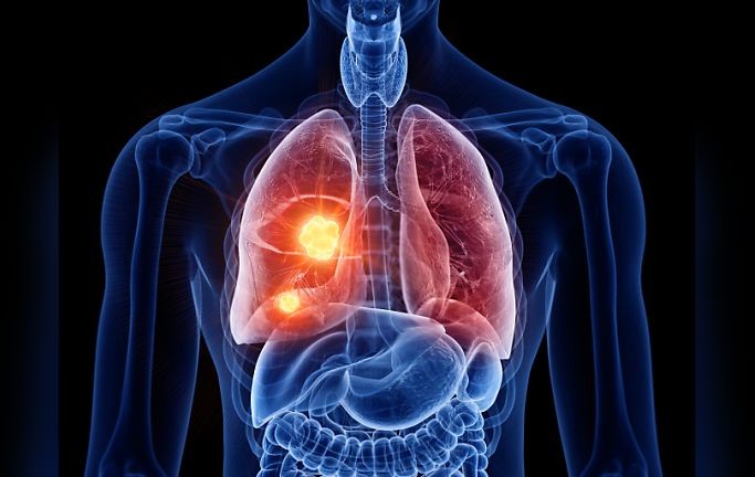 Nghiên cứu thuốc dạng uống hàng ngày cho phép giảm nguy cơ tử vong vì ung thư phổi tới 51%. 