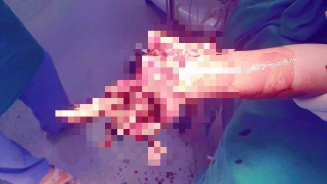 Hình ảnh bàn tay phải của nam sinh  Phạm Xuân L. bị dập nát. Ảnh: Bệnh viện Nhi Thanh Hóa cung cấp. 