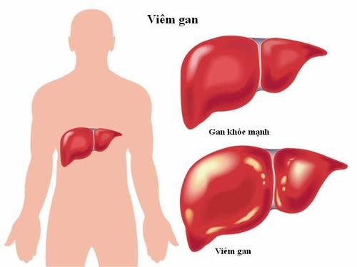  Số liệu giật mình về viêm gan ở Việt Nam