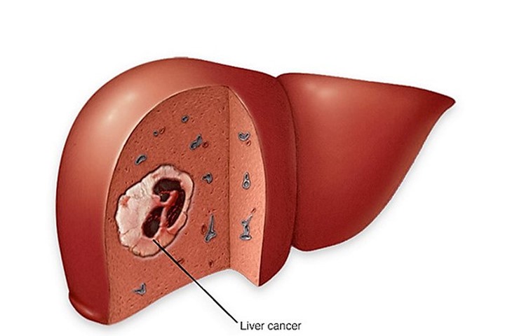 Minh họa khối u ung thư gan Ảnh: MAYO CLINIC