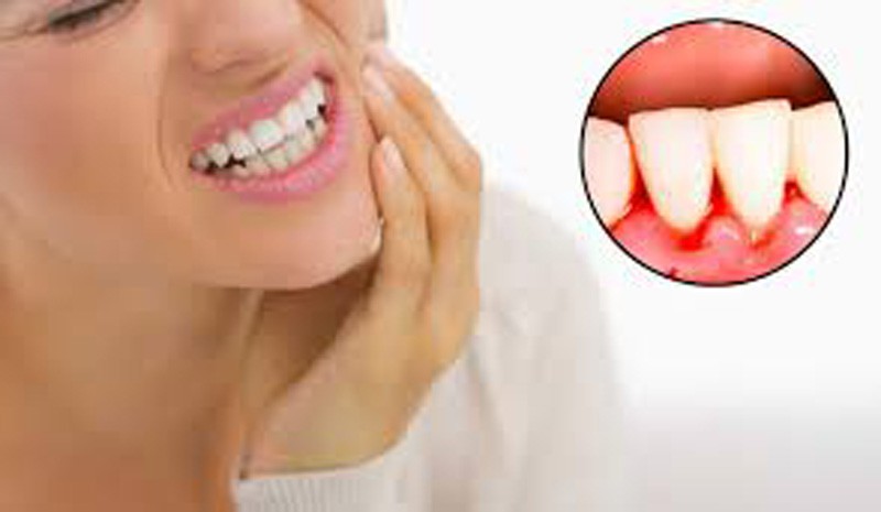 Chảy máu chân răng: Dấu hiệu cảnh báo căn bệnh nguy hiểm, chớ coi thường