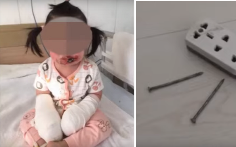 Bé gái 2 tuổi bị bỏng nặng do điện giật bởi một vật ít ai ngờ tới