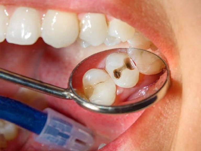 Thấy răng xuất hiện điểm “lạ” này cần đi kiểm tra càng sớm càng tốt
