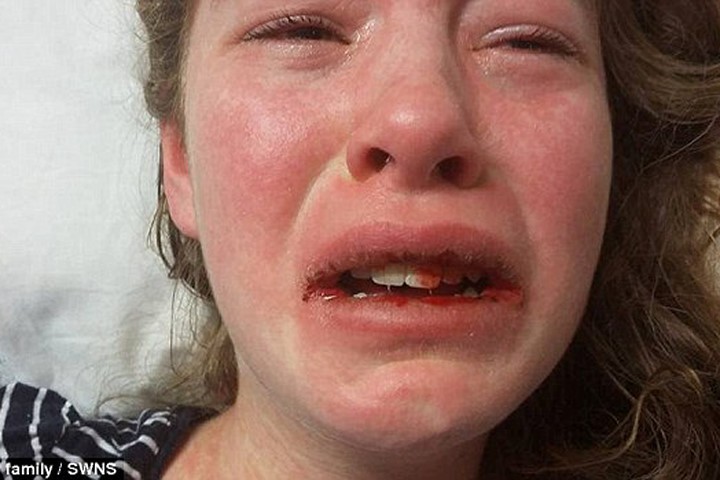 Bí ẩn căn bệnh bắt nguồn từ vết muỗi đốt khiến thiếu nữ 15 tuổi mất trí nhớ, chảy máu miệng