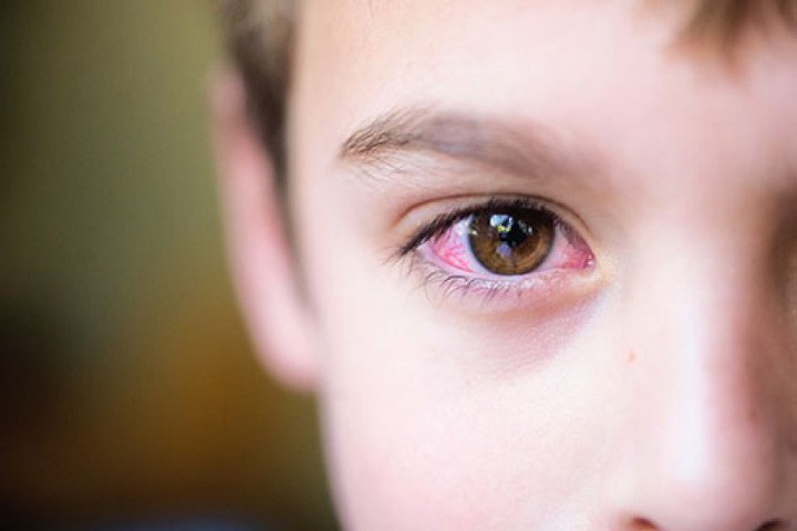 Nhiều phụ huynh chủ quan không sớm nhận ra triệu chứng bệnh đau mắt đỏ của con. Ảnh minh họa