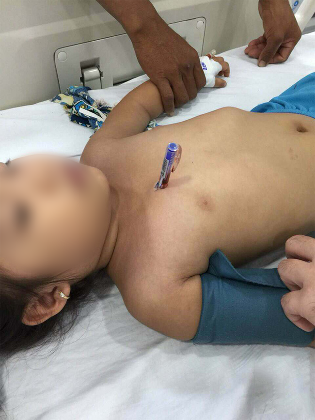 Cảnh báo cho các bậc cha mẹ: Cầm bút bi chạy, bé gái 4 tuổi bị bút đâm xuyên thấu ngực