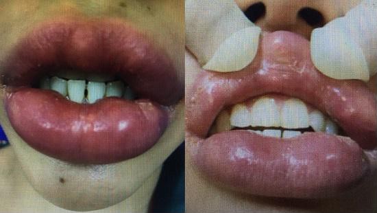 Hình ảnh đôi môi của bệnh nhân bị biến chứng khi tiêm filler làm đẹp. Ảnh: BVCC