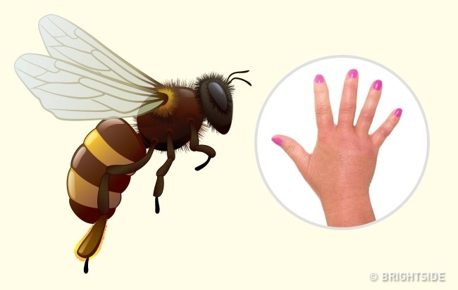  “Nhận dạng” vết cắn côn trùng bằng những cách cực đơn giản để tránh nguy hiểm ngoài da