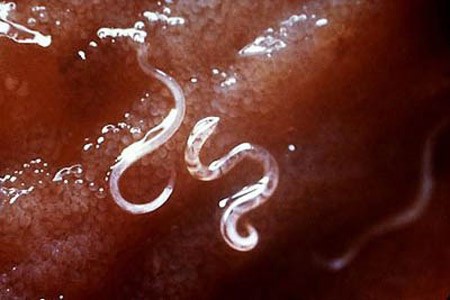 Việt Nam được công nhận loại trừ bệnh giun chỉ bạch huyết