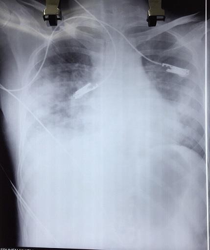 Hình ảnh bệnh nhân viêm phổi do thủy đậu