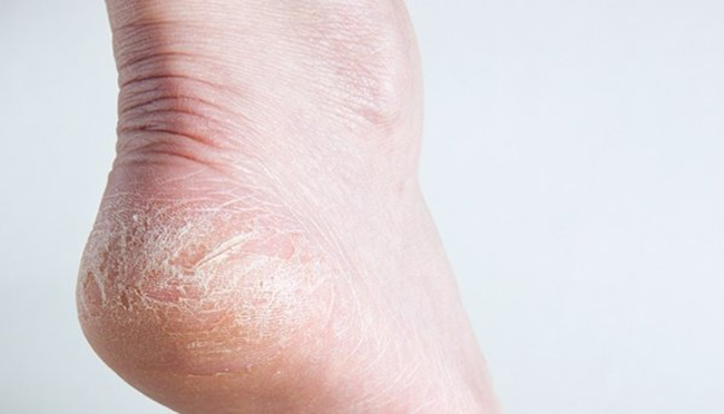 Nút gót chân đôi khi gây viêm và chảy máu.