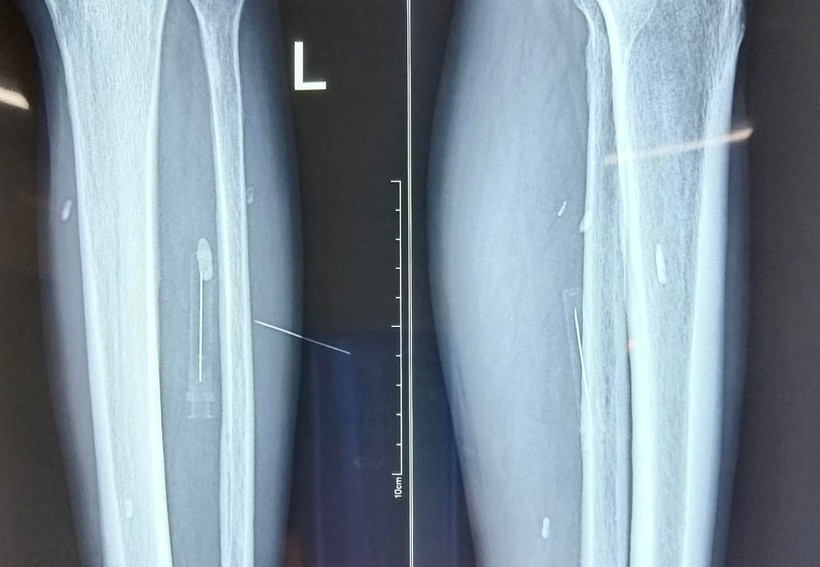 Mảnh đạn pháo nằm trong chân trái của bệnh nhân Minh. Ảnh: BV CA tỉnh Tuyên Quang