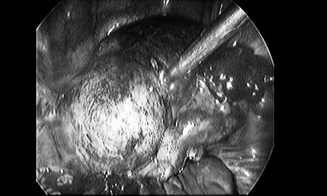 Hình ảnh khối u của nữ bệnh nhân người Vĩnh Phúc