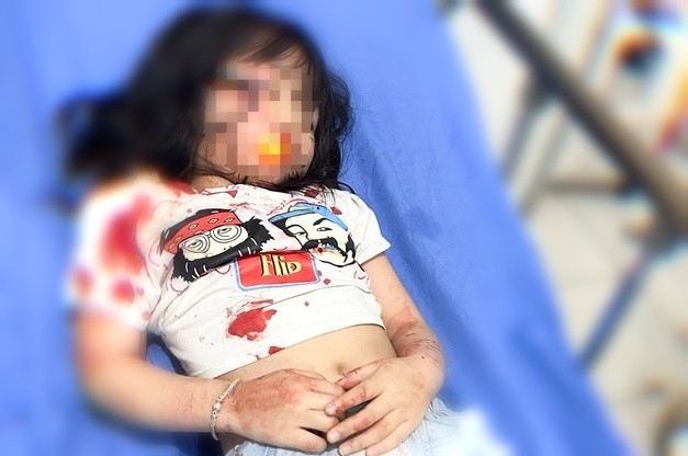 Bé gái 5 tuổi ở Hà Giang bị chó dữ cắn trọng thương