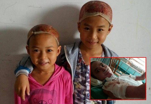 Hai đứa trẻ sau khi trải qua ca phẫu thuật lột da đầu để hiến da cứu cha. Ảnh: CCTVNews.