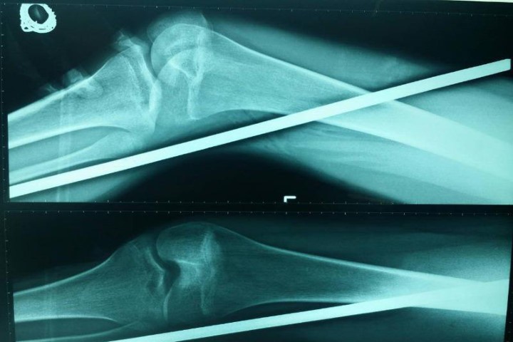 Kết quả chụp X quang cho thấy cây sắt đâm xuyên từ đùi xuống gần mắt cá chân trái. Ảnh: Đăng Khoa