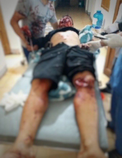 Hà Tĩnh: Nam thanh niên bị mất bàn tay sau vụ nổ lớn