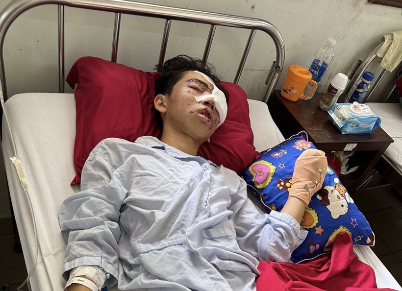 Em Võ Tuấn Tú bị dập tay, hỏng mắt sau vụ tai nạn nổ bình ga mini.