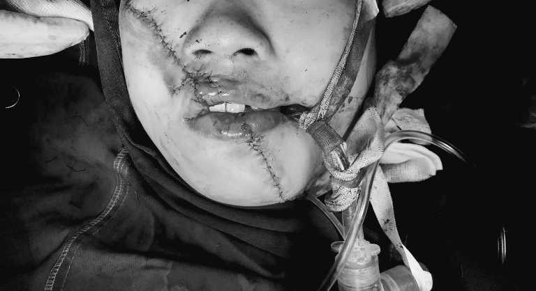 Tạo hình thành công khuôn mặt bị dập nát do tai nạn cho người phụ nữ