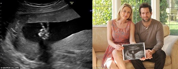 Hành động của thai nhi qua ảnh siêu âm khiến bố mẹ và bác sĩ tròn mắt ngạc nhiên