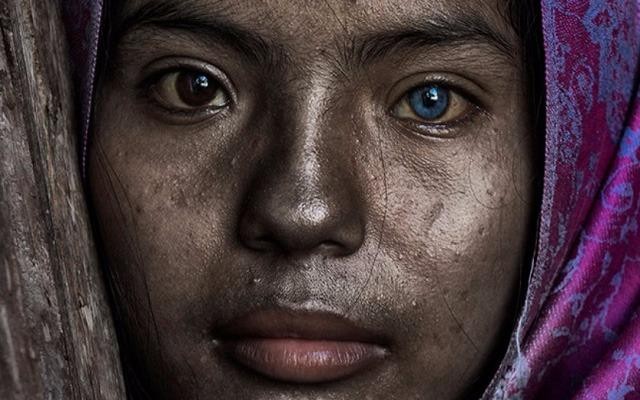 Cô gái Việt mang hai màu mắt kỳ lạ trên báo nước ngoài    