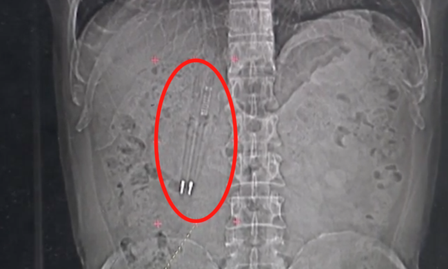 Phim chụp X quang cho thấy 2 chiếc bút bi vẫn còn nằm lại trong cơ thể ông Wang sau 36 năm.