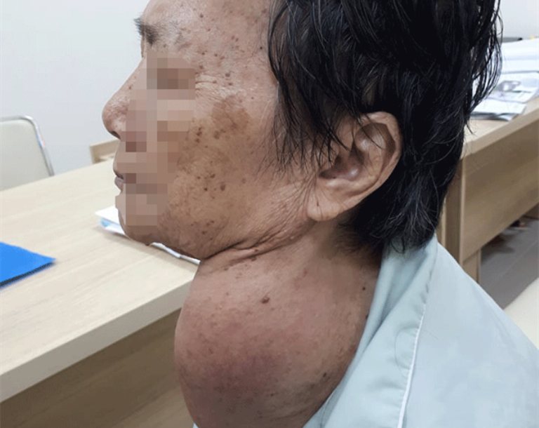 Bệnh nhân Lê Thị T., 73 tuổi có khối bứu khổng lồ đã được phẩu thuật thành công nhờ phương pháp mới ứng dụng đèn soi thanh quản tự chế



