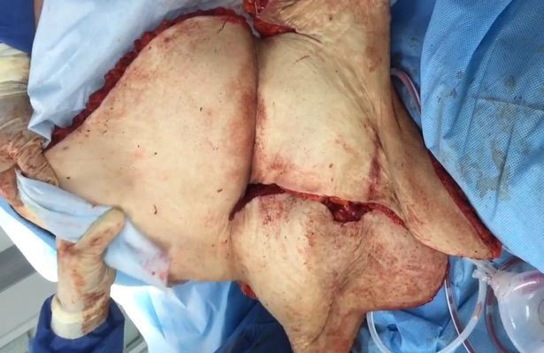 Sởn da xem gần 8kg mỡ bụng thừa của bệnh nhân béo phì được cắt bỏ