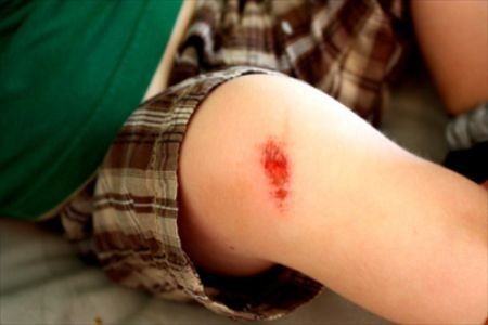 Vết trầy xước, đứt tay rất lâu lành, có phải do da “dữ“: Vấn đề nghiêm trọng hơn bạn nghĩ